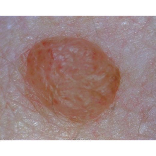 MEDL4D DermaScope (1.3MPix)