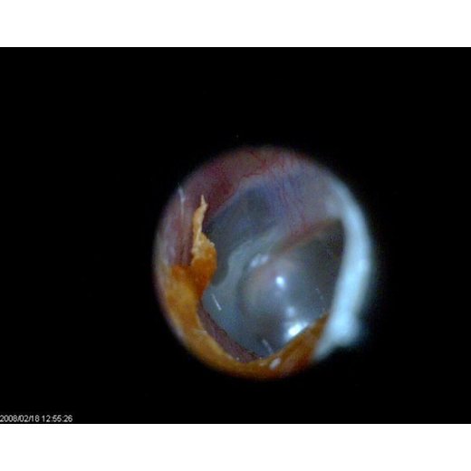 MEDL3E EarScope Basic (0.3MPix)