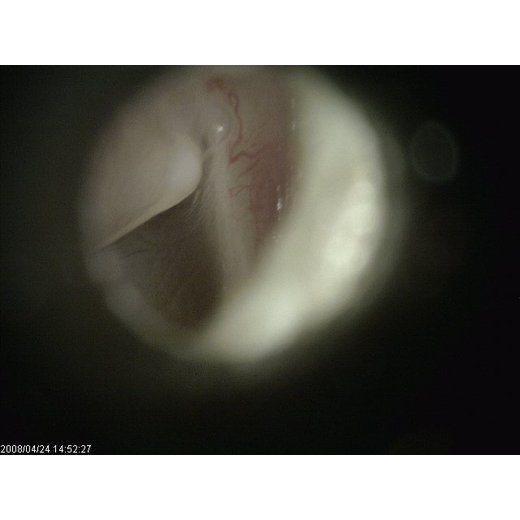 MEDL3E EarScope Basic (0.3MPix)