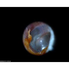 EarScope 