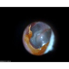 EarScope 