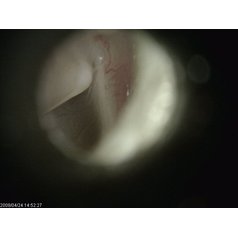 EarScope 