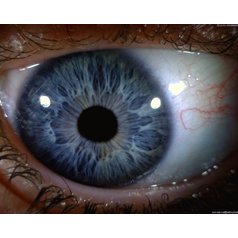 MEDL4R IriScope 