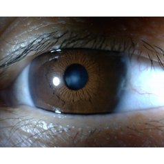 MEDL4R IriScope 