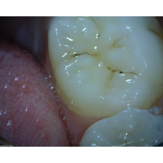 MEDL4T DentalScope (1.3MPix)