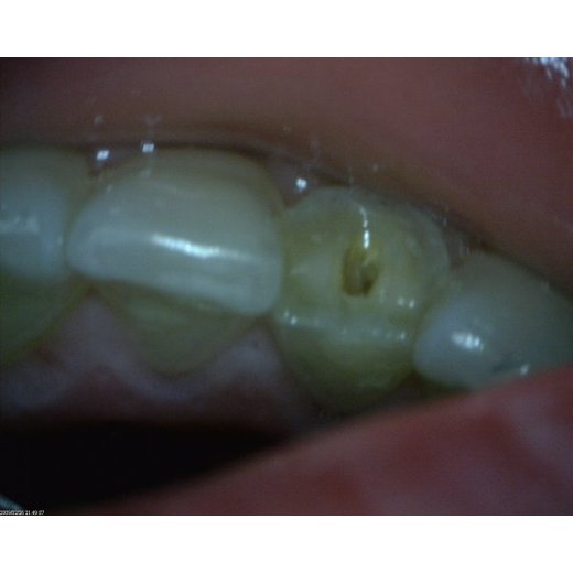 MEDL4T DentalScope (1.3MPix)