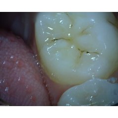 DentalScope MEDL4T